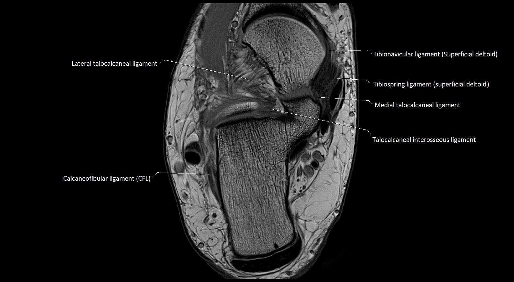 MRI ankle ligaments anatomy axial 3T image 15.webp